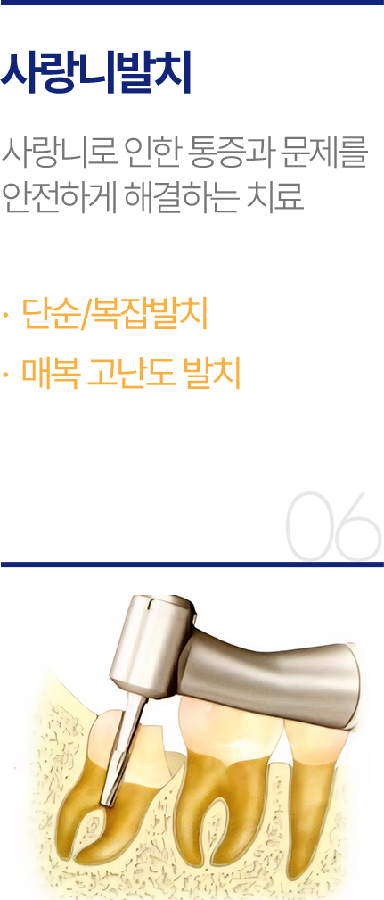 사랑니발치
