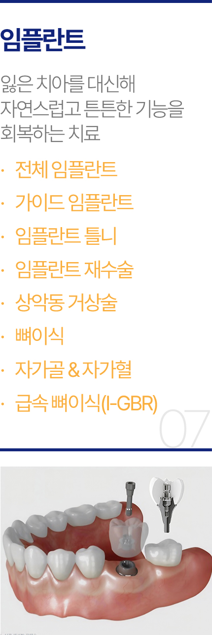 임플란트