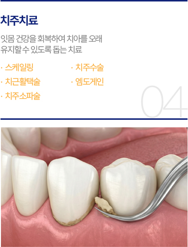 치주치료